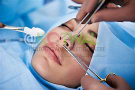 Rhinoplasty